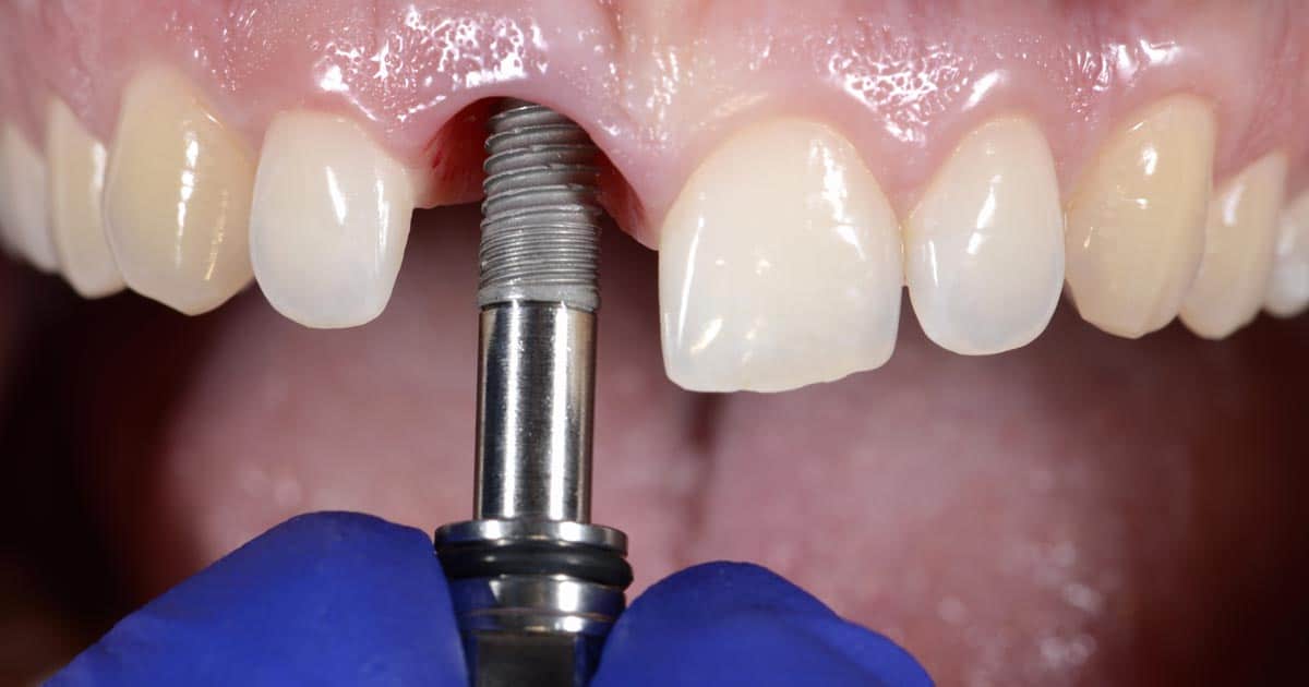 En este momento estás viendo ¿Cuál es el Precio de un Implante dental en Colombia este 2024? 